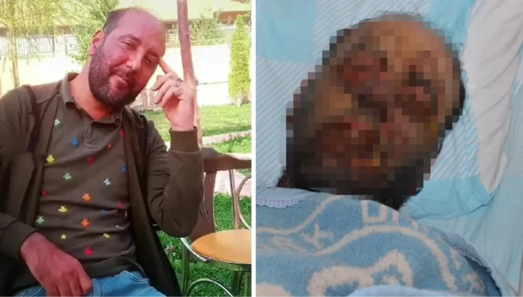 Yağmur ormanlarında görülen hastalık Erzurum’da: Kimsenin yüzüne bakamıyorum