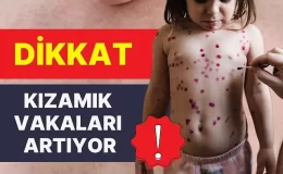 Dr. Ayşe Sayılı Erenler, ”çocukluk çağı kızamık vakalarının sayısındaki artış endişe vericidir, tedbir alın”