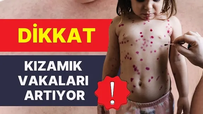Dr. Ayşe Sayılı Erenler, ”çocukluk çağı kızamık vakalarının sayısındaki artış endişe vericidir, tedbir alın”