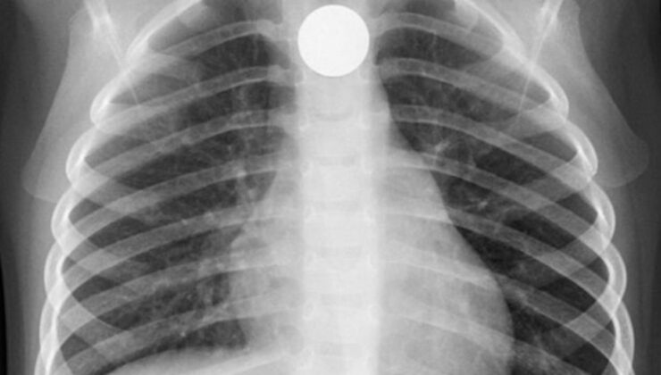 806 TL'lik yumurtayı yuttu, polis karnından çıkarmaya çalışıyor