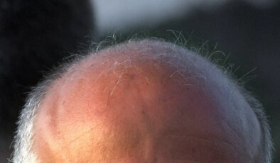 Tıp tarihinde dönüm noktası: Erkek tipi kellik için ilaç bulundu