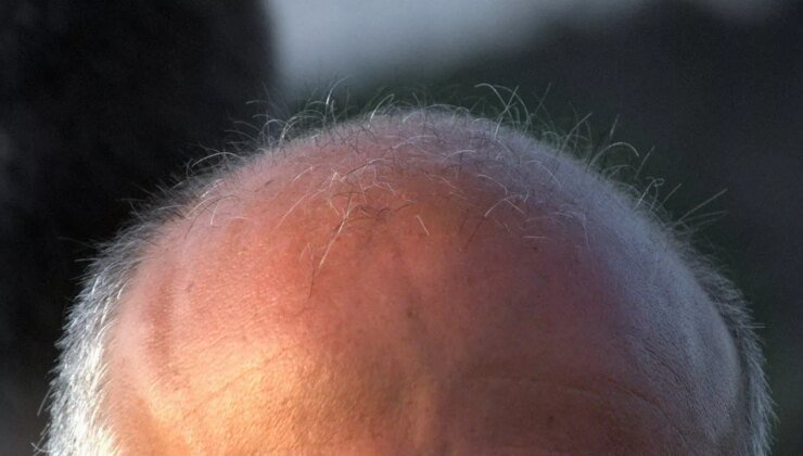 Tıp tarihinde dönüm noktası: Erkek tipi kellik için ilaç bulundu