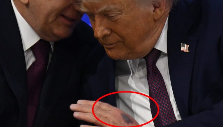 Trump'ın elindeki morluğun nedeni belli oldu