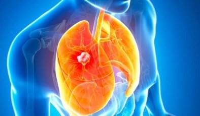 Akciğer kanserinin en erken evresini saptayabilen kan testi geliştirildi