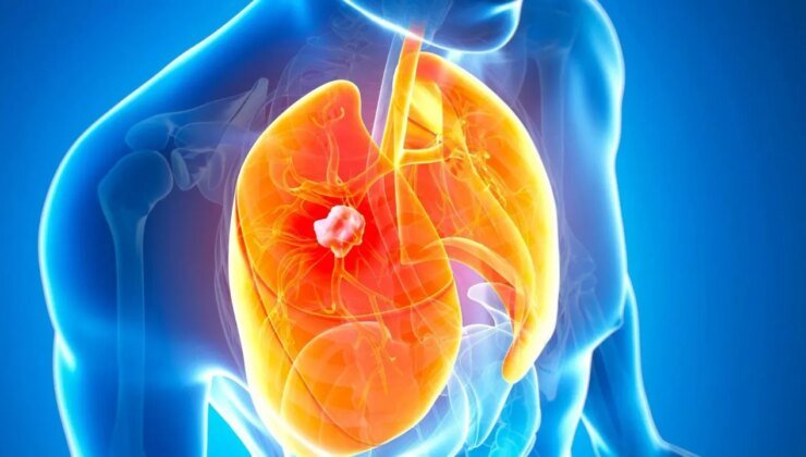 Akciğer kanserinin en erken evresini saptayabilen kan testi geliştirildi