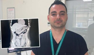 Zayıflamak isterken 13 santimetrelik diş fırçası yuttu: Doktorlar bile şaştı kaldı