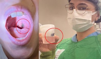 Burun kanamasıyla hastaneye gitti, boğazından çıkan şey doktorları bile şaşırttı