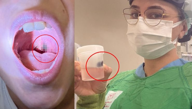 Burun kanamasıyla hastaneye gitti, boğazından çıkan şey doktorları bile şaşırttı